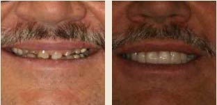before-after-smile